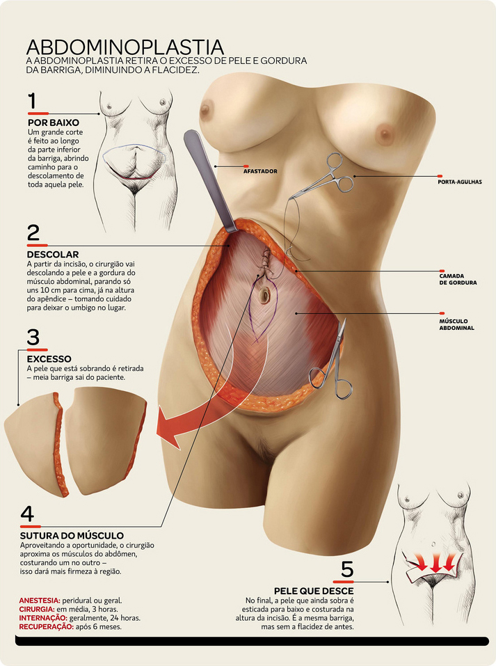 Abdominoplastia - Clínica Avril