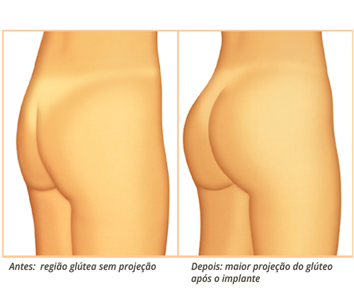 Aumento de Glúteos (Próteses/Implantes de Glúteos) - Nurkim